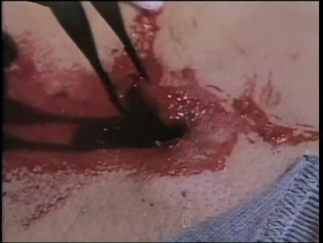 Close-up of tweezers removing bullet from bloody bullet hole