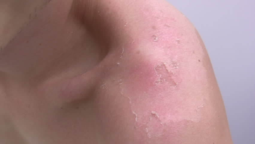 Man Peeling Skin from sun burnt Shoulder