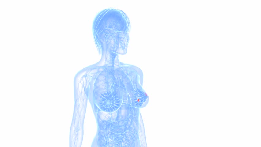 breast cancer