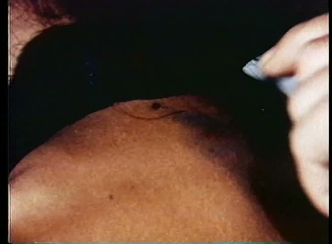 Close-up of hand sticking acupuncture needles in skin