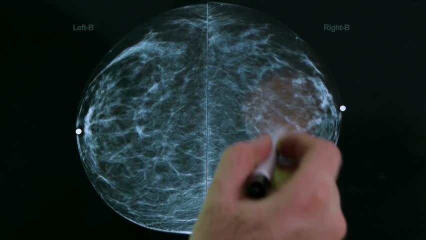 Mammogram X Ray Analysis (HD) by a Doctor's hand and pen lamp showing fibroid tissue growths.