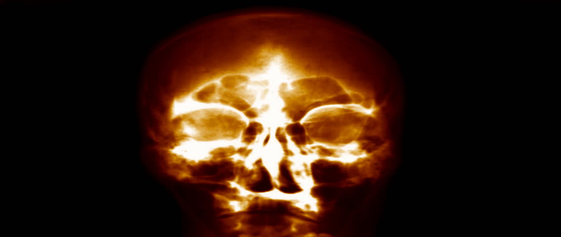 Radiology nuclear skull xray