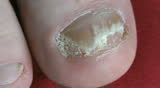 Fungus toenail infection