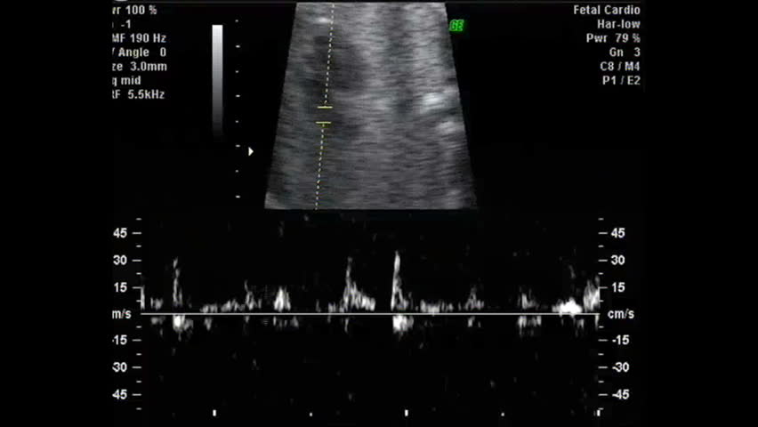 Ultrasound screen of human fetus heartbeat recording
