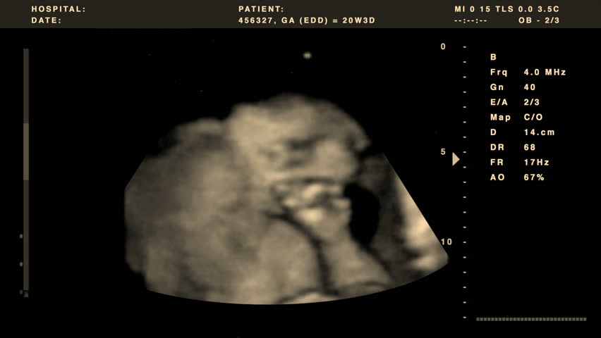 Video out put from a 4D ultrasound combined with graphics.