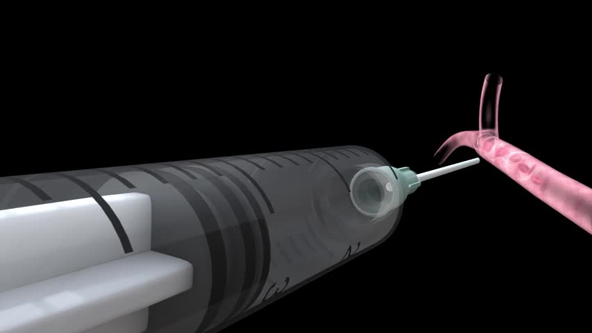 Close up 3D perspex see through syringe with needle injecting into vein showing valves red blood cells plus impurities of illicit drug injection 
