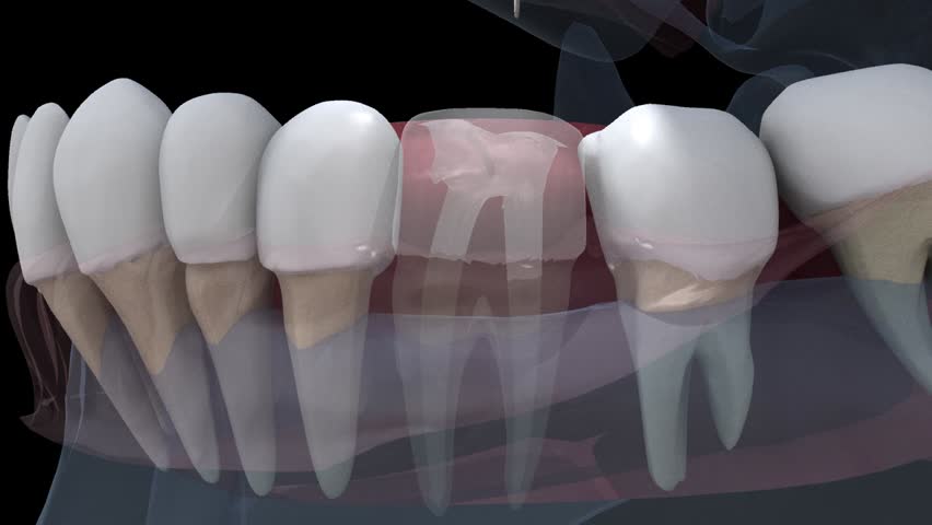 Side view of perspex see through  3D root canal therapy amidst surrounding teeth and dental instrument used black background 
