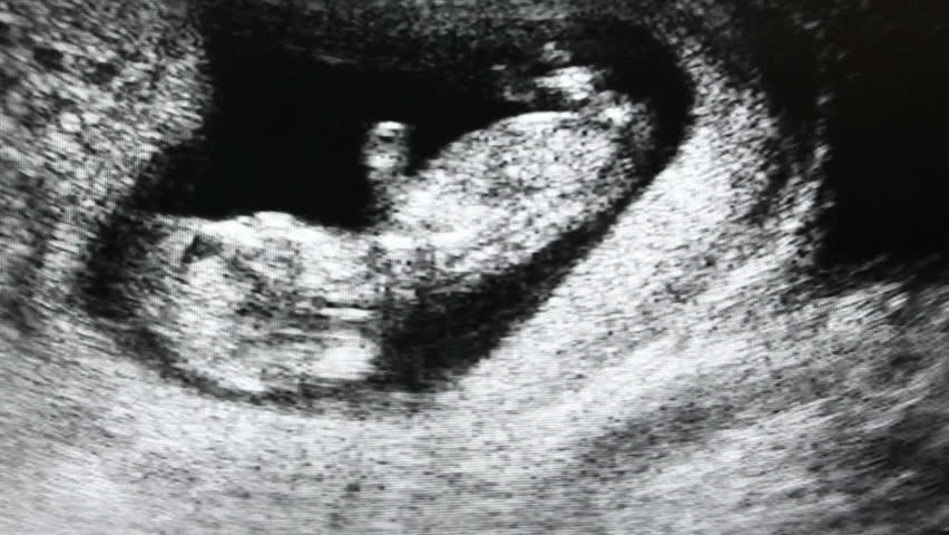 Medical ultrasound scan of human embryo		 