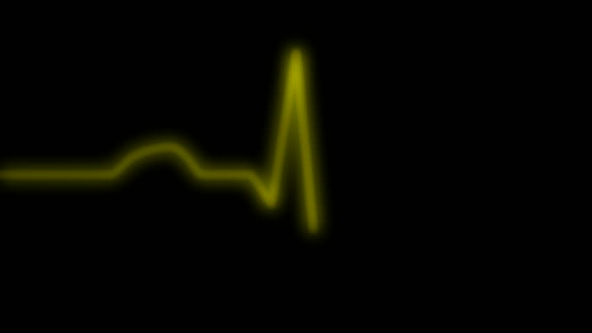 HD ECG / EKG-curve. A typical ECG tracing of a normal heartbeat (or cardiac cycle) consists of a P wave, a QRS complex and a T wave. Yellow line without monitor grid.