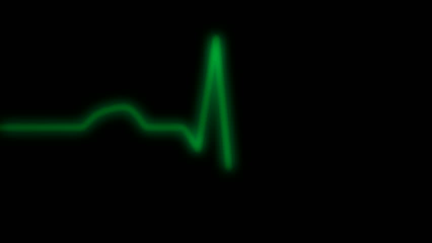 HD ECG / EKG-curve. A typical ECG tracing of a normal heartbeat (or cardiac cycle) consists of a P wave, a QRS complex and a T wave. Green line without monitor grid.