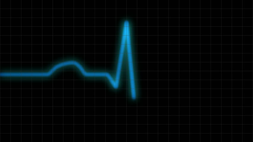 HD ECG / EKG-curve. A typical ECG tracing of a normal heartbeat (or cardiac cycle) consists of a P wave, a QRS complex and a T wave. Blue line with monitor grid.