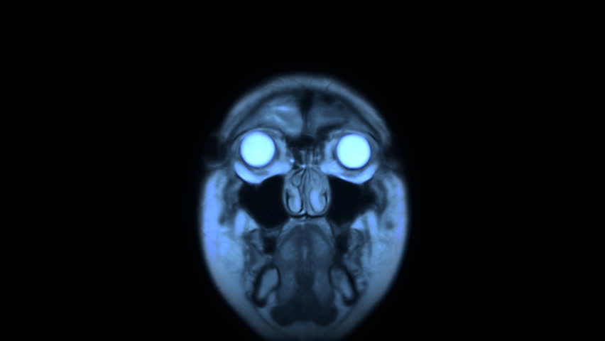 MRI brain scan