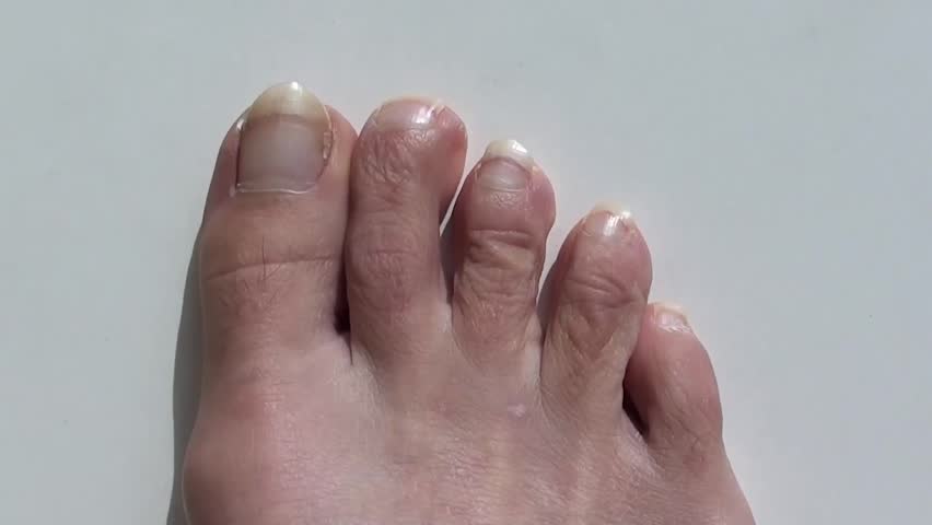 Bruised Toenails Big Toe