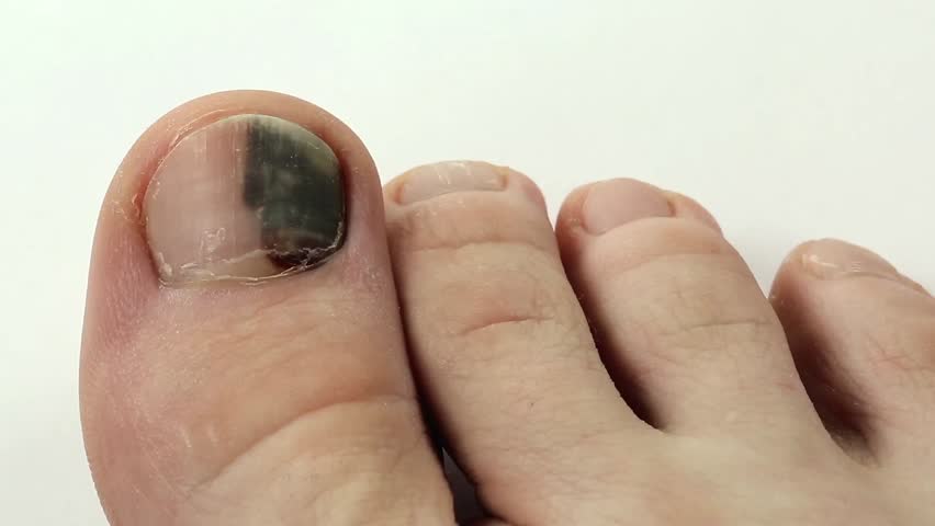 Trauma Of Toenail Subungual Hematoma Bruise Under The Nail Of Big Toe 