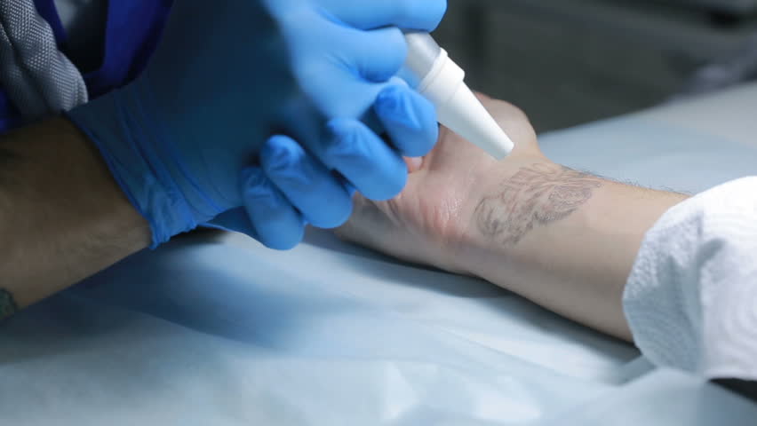 laser tattoo removal with hand stock footage video 22185052 laser tattoo removal with hand stock footage video 22185052