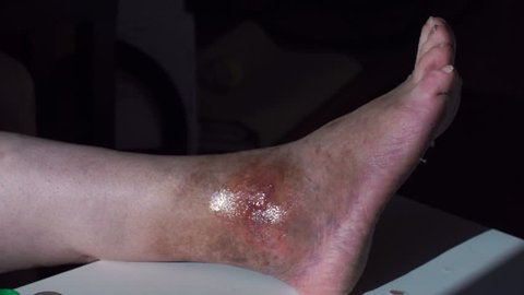 Diabetic Leg Ulcers Stock Video Footage - 4K and HD Video Clips