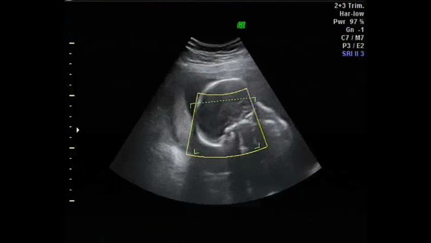 Header of pregnancy