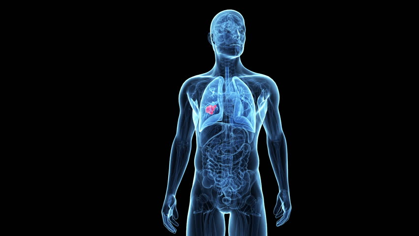 Header of tumor