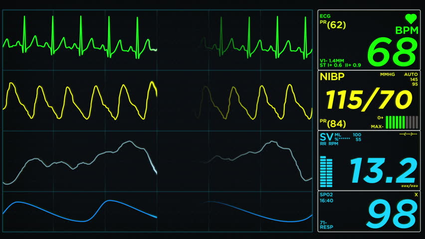 Erratic EKG, Oxygen Saturation, Respiration Wave Patterns ...